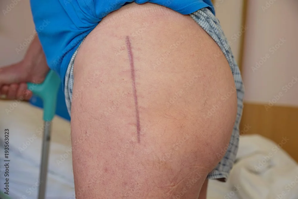 Hip Operation Scars
